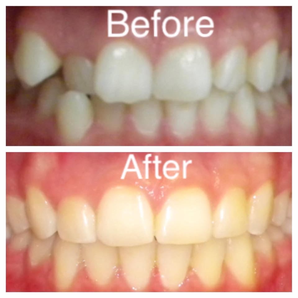 before and after with braces