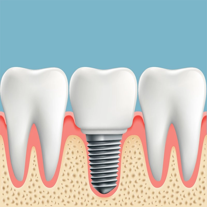 info about dental implants