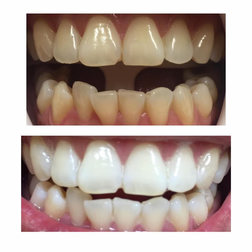 whitening before and after